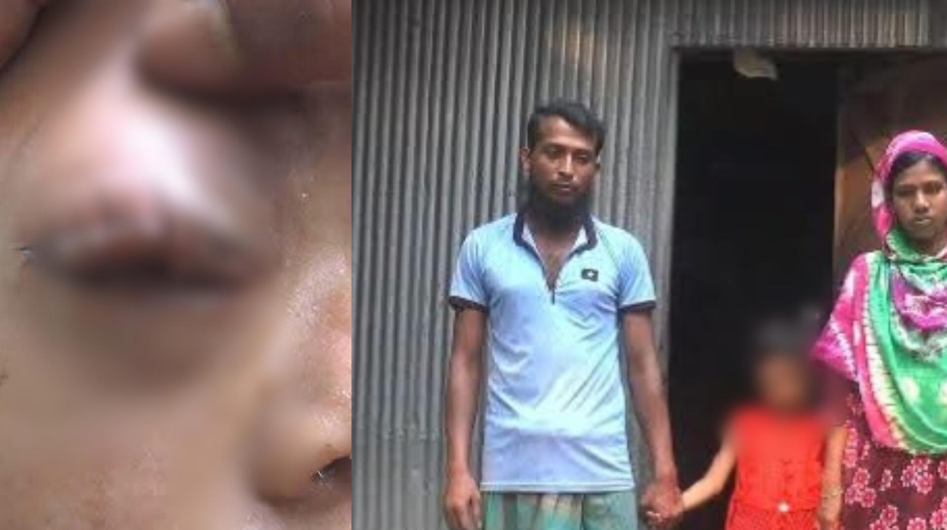 গাইবান্ধায় ব্রেন টিউমারে আক্রান্ত শায়রা কে বাঁচাতে বাবা-মায়ের আকুতি, - Chief TV